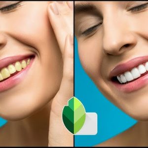 Teeth Whitening