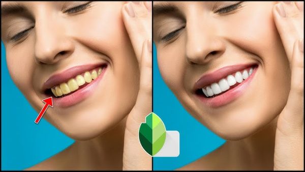 Teeth Whitening